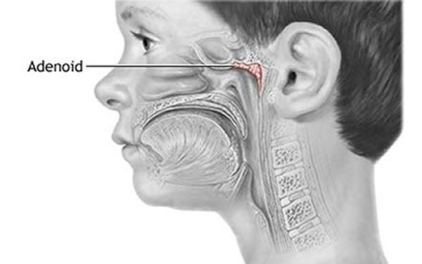 Adenoid