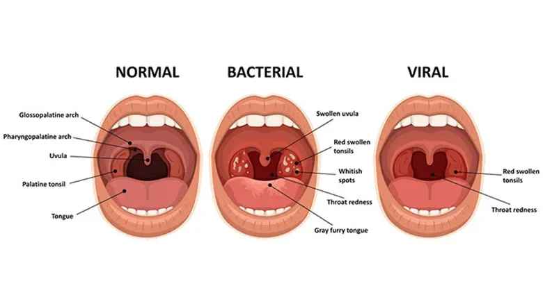 Tonsil normal dan abnormal