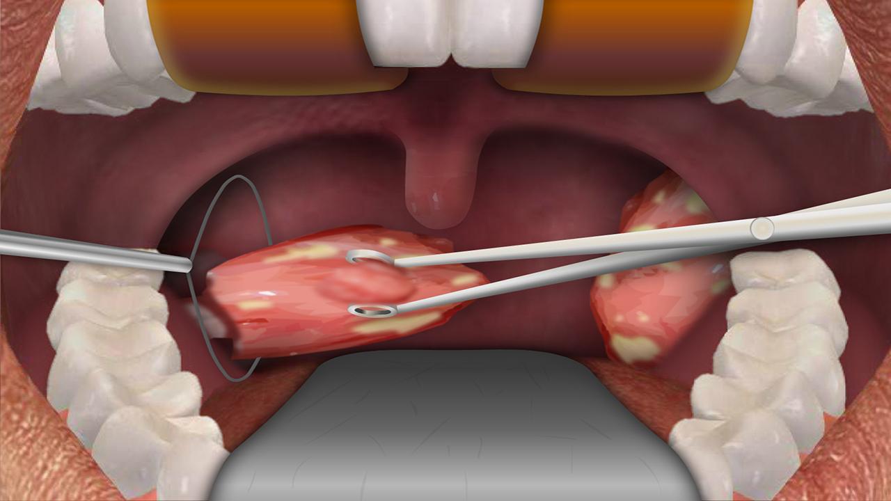 Operasi tonsil